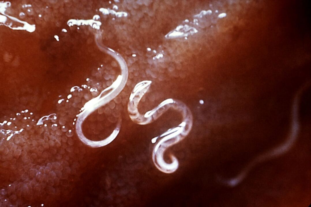 Helminths in the human body.